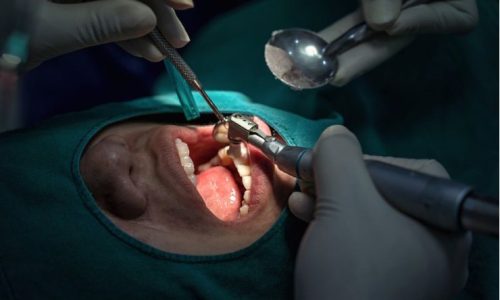 Oral Surgery